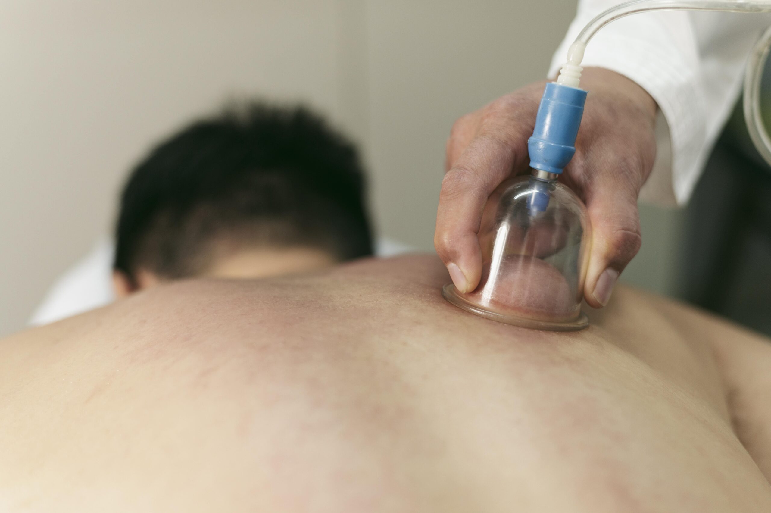 Cupping Therapy (Hijama) in Keshavnagar, Mundhwa | Rudrani
