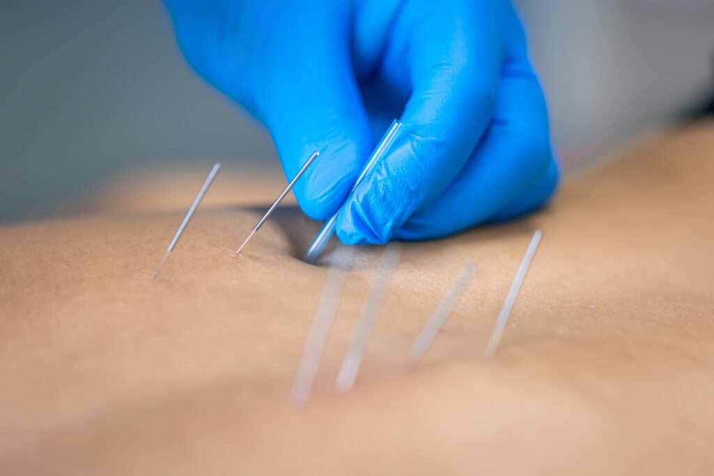 Dry Needling Treatment in Keshavnagar, Mundhwa | Rudrani