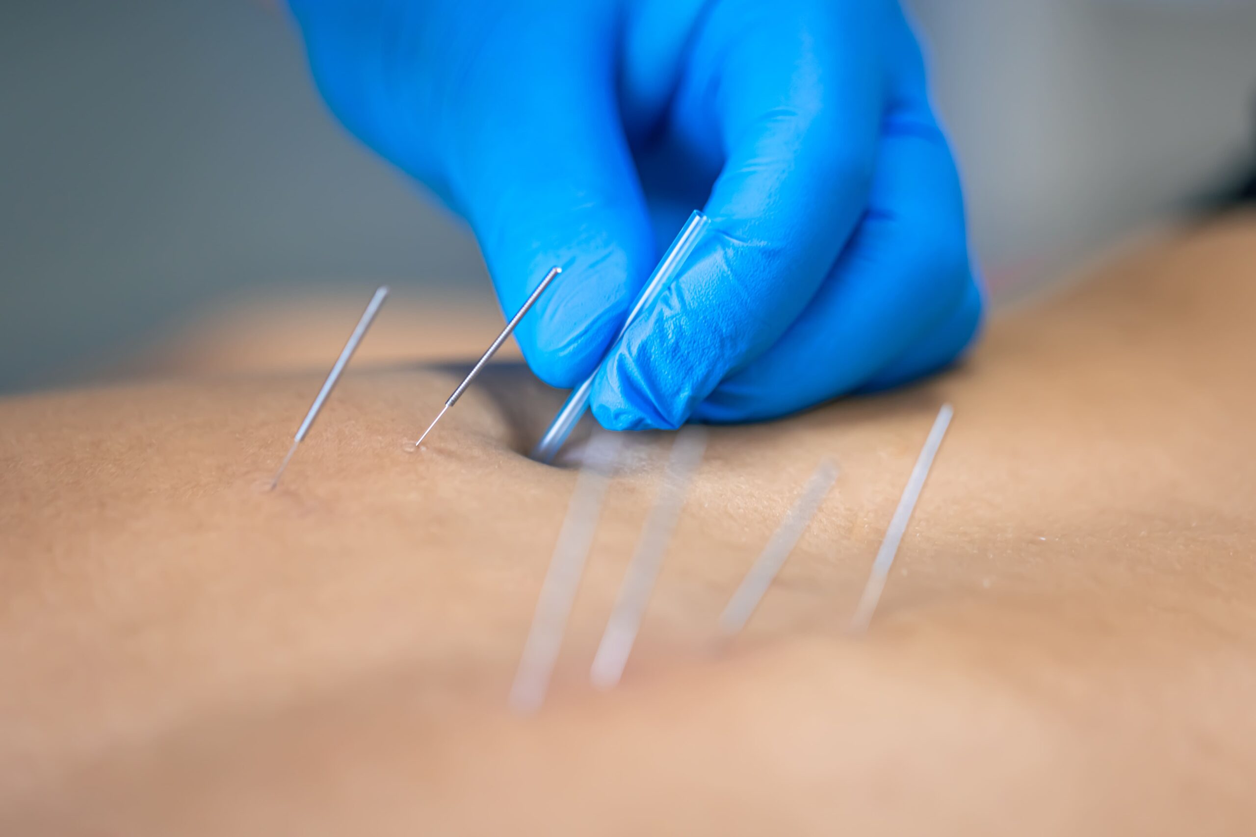 Dry Needling Treatment in Keshavnagar, Mundhwa | Rudrani